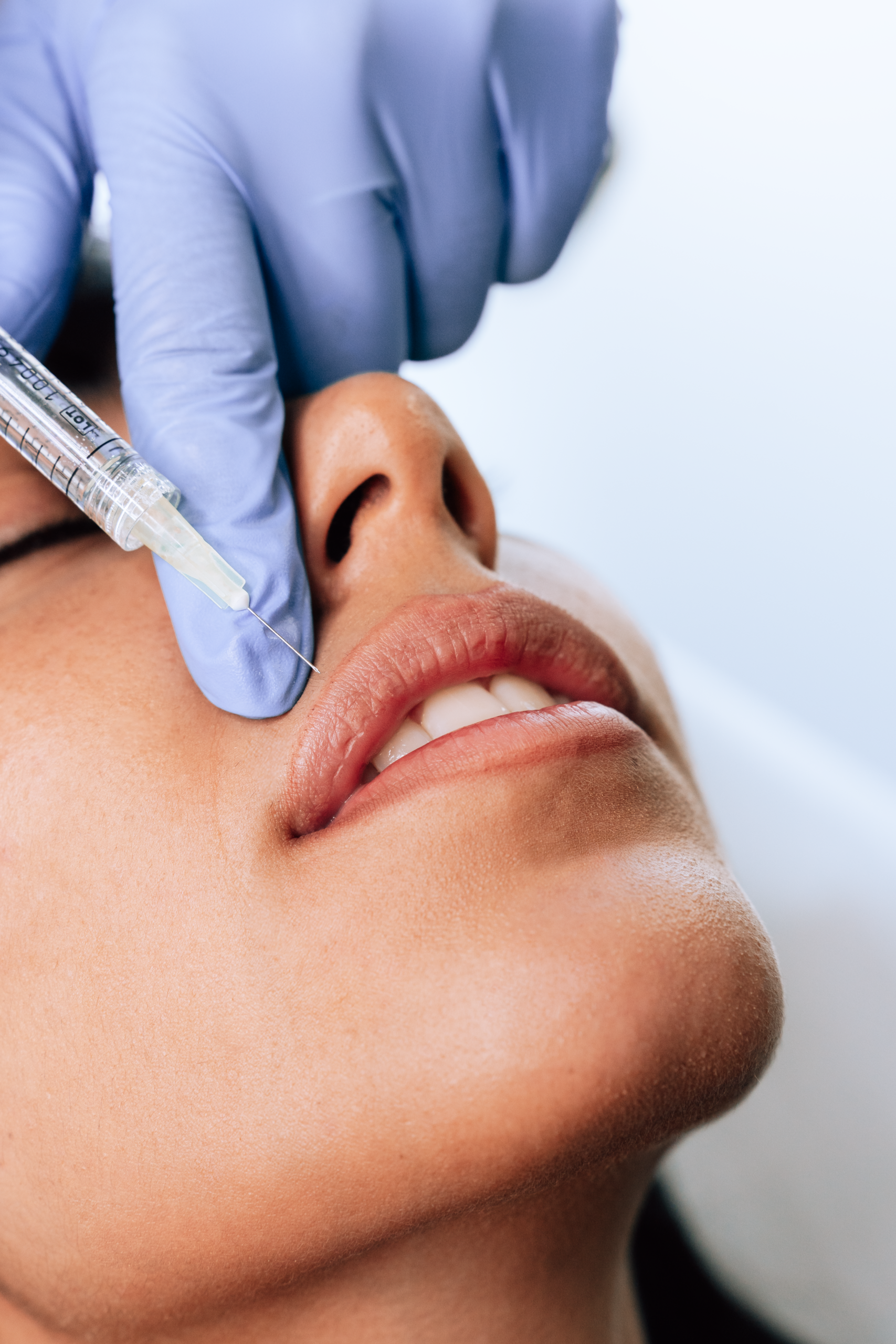 Filler Labbra