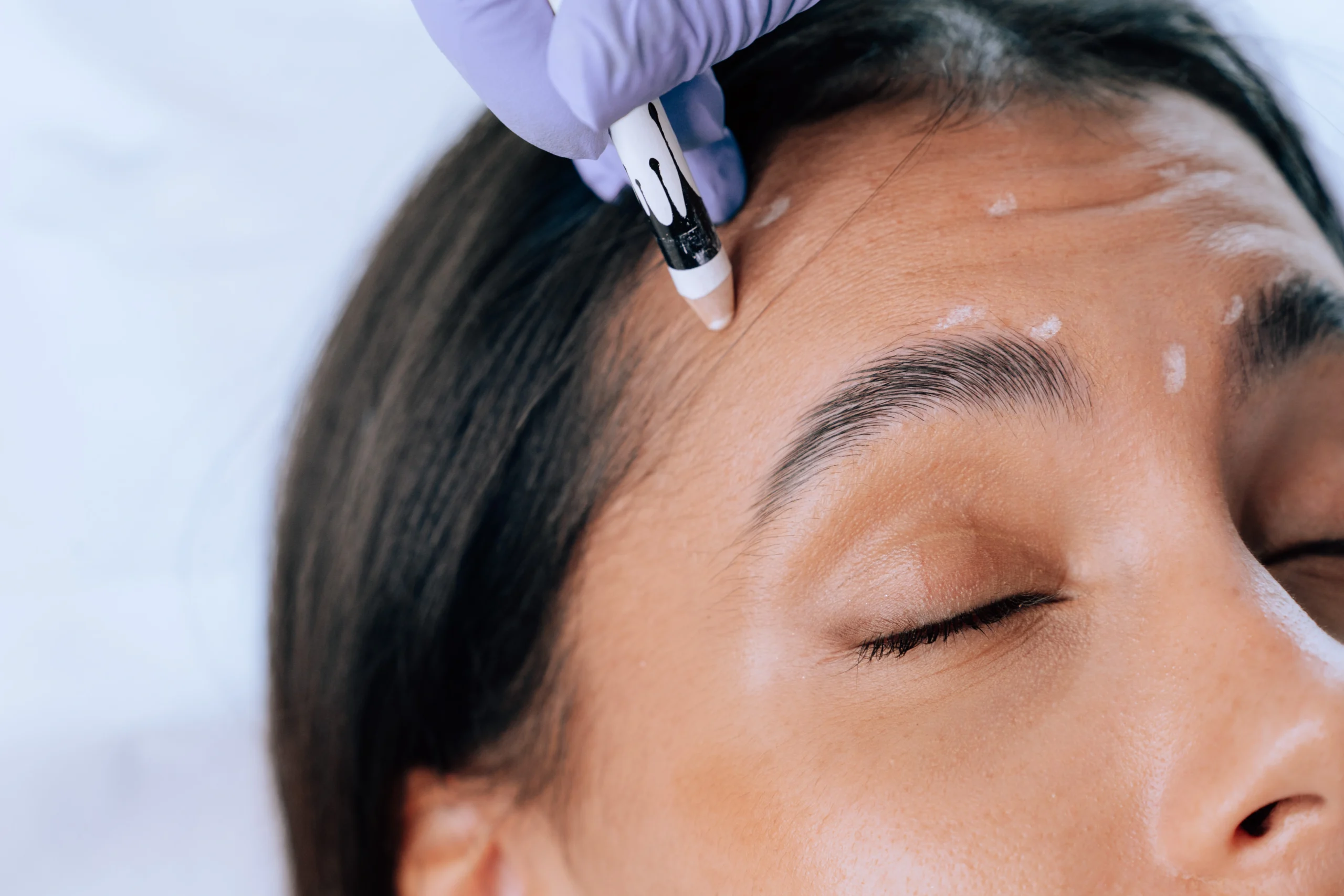 Botox Rughe d’Espressione